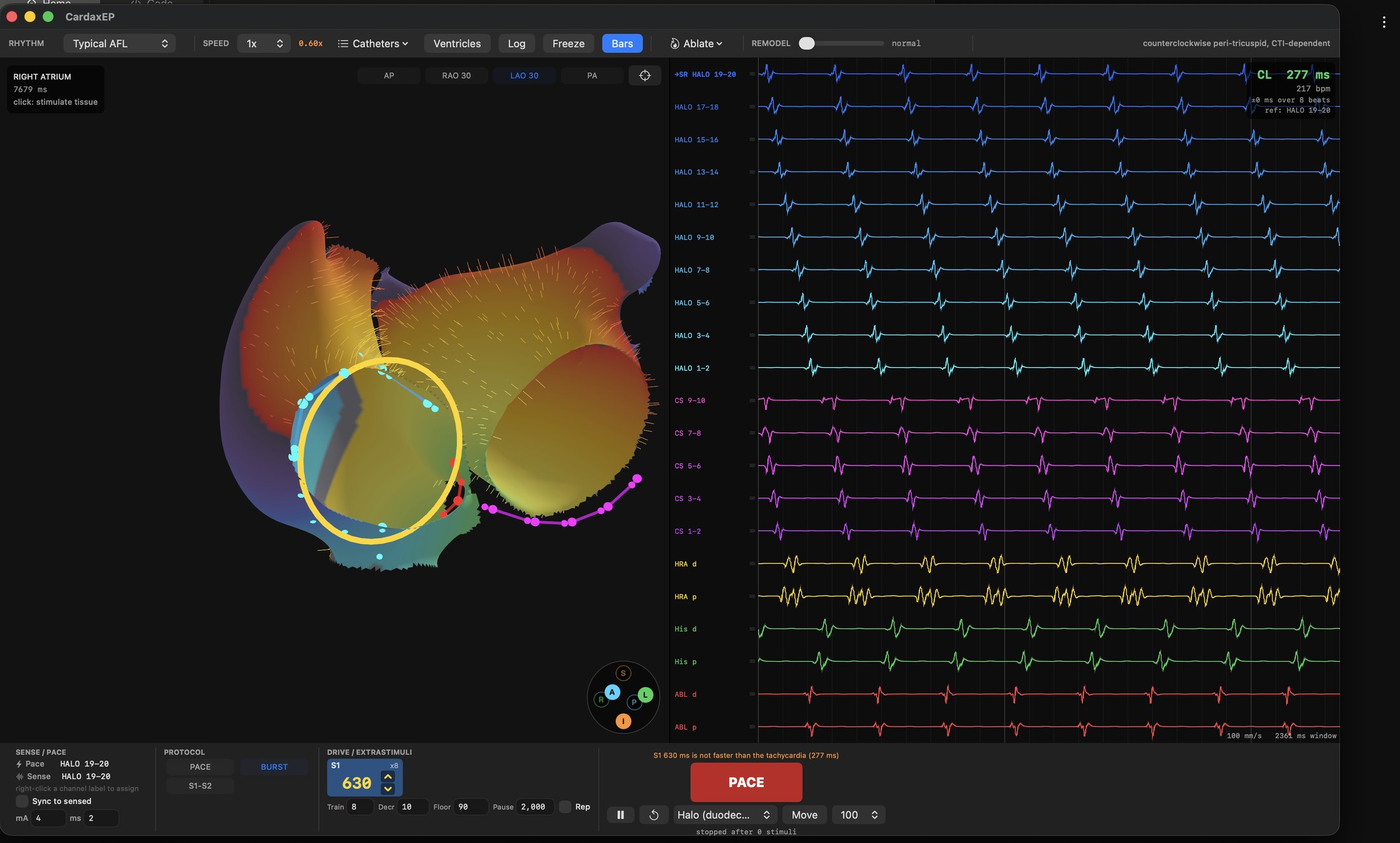 CardaxEP interface showing a bi-atrial activation map with a peri-tricuspid reentrant circuit alongside a 20-channel intracardiac electrogram display