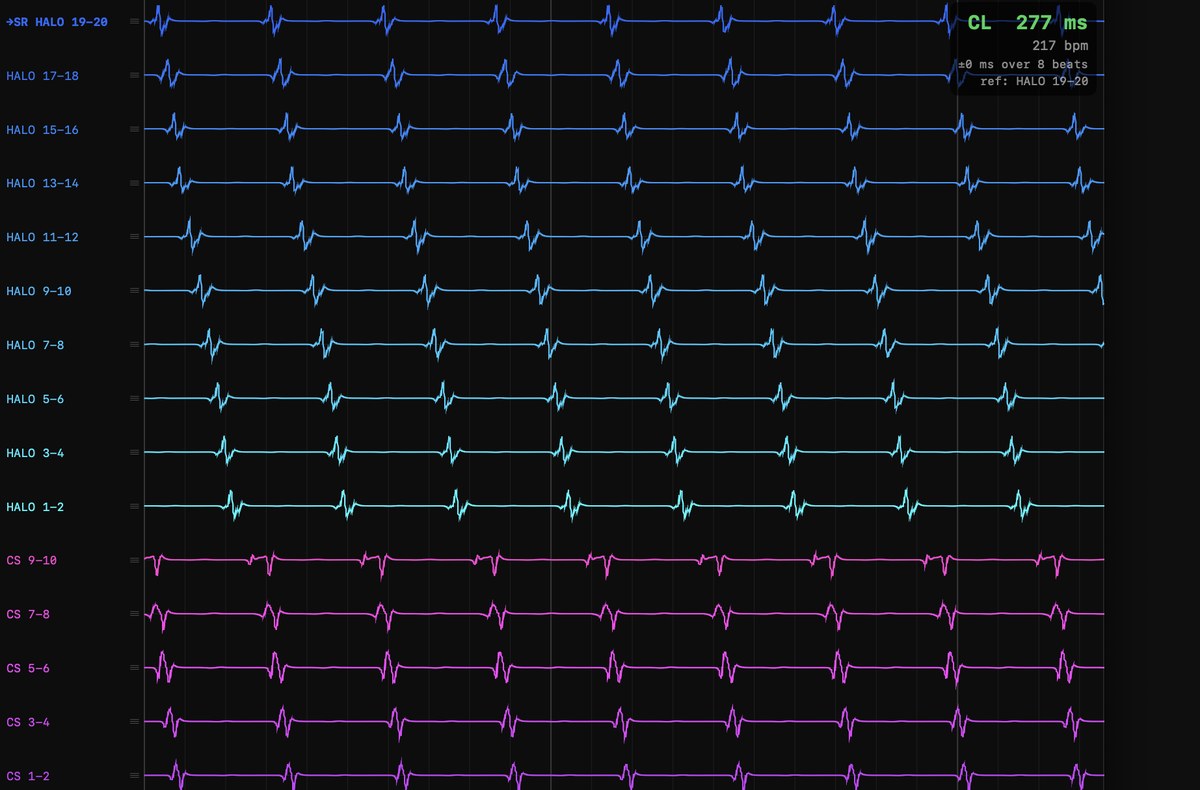 Twenty-channel intracardiac electrogram display showing sequential Halo activation with coronary sinus and His recordings