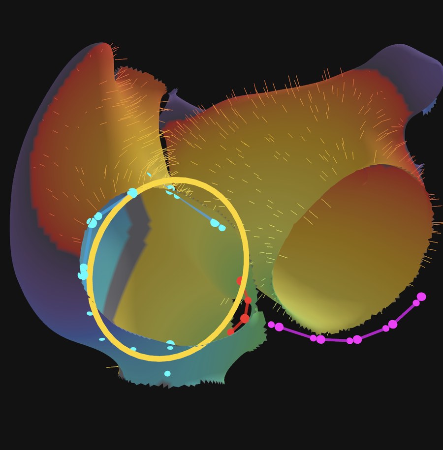 Three-dimensional bi-atrial activation map with fiber vectors and an ablation line encircling the cavotricuspid isthmus region