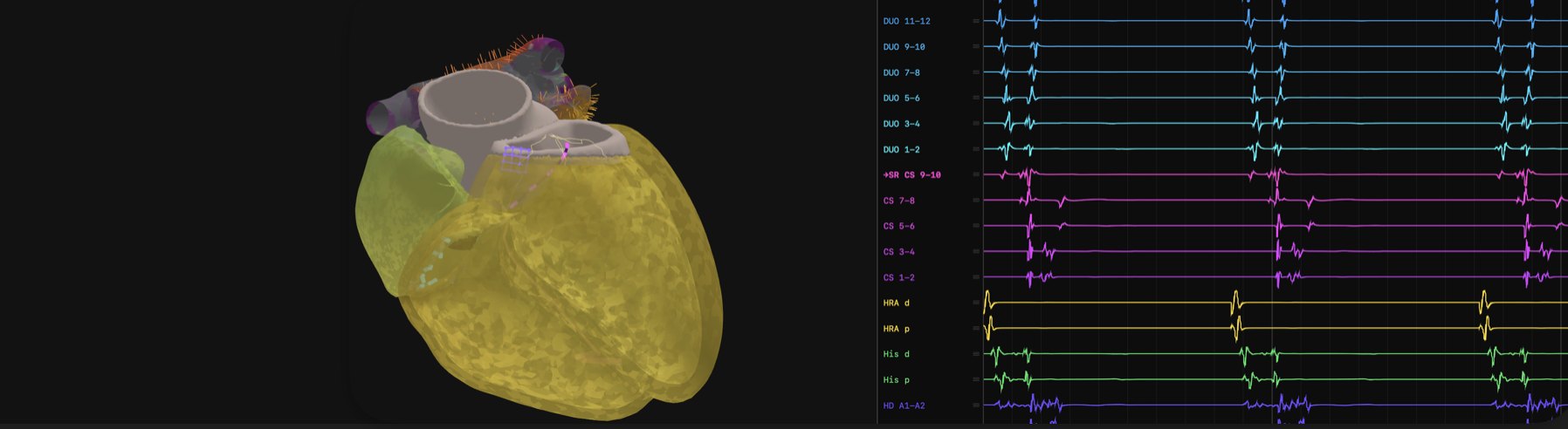 Four-chamber heart model beside intracardiac electrograms