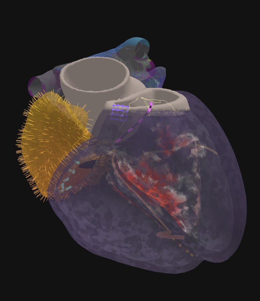 Translucent four-chamber heart with high-density mapping vectors over the right atrium and the ventricular conduction system visible