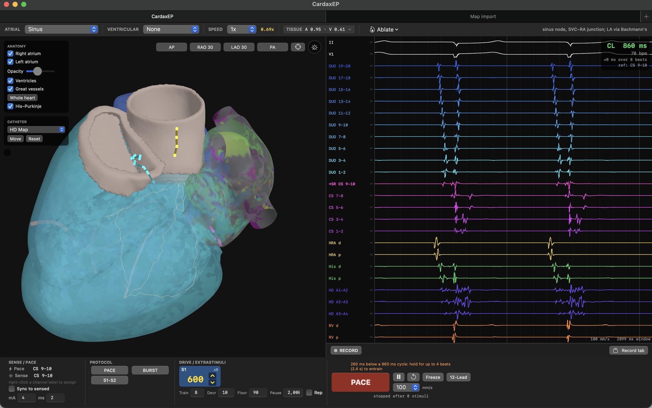 CardaxEP showing a translucent four-chamber heart model with conduction system and catheters, alongside surface ECG and a multi-catheter intracardiac electrogram display in sinus rhythm