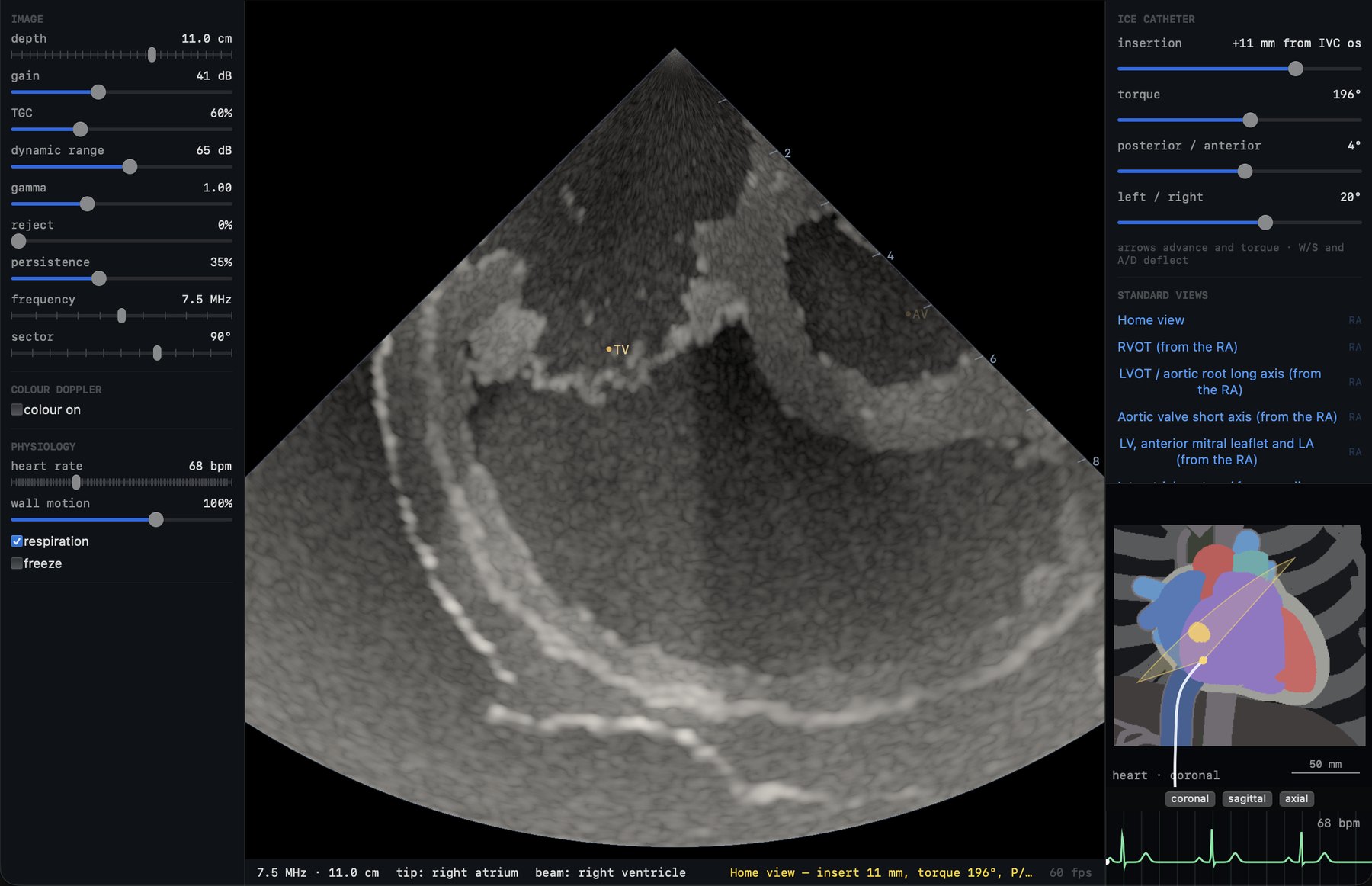 Simulated intracardiac echocardiography view from the right atrium with imaging controls, catheter steering, standard-view presets and an anatomic orientation inset